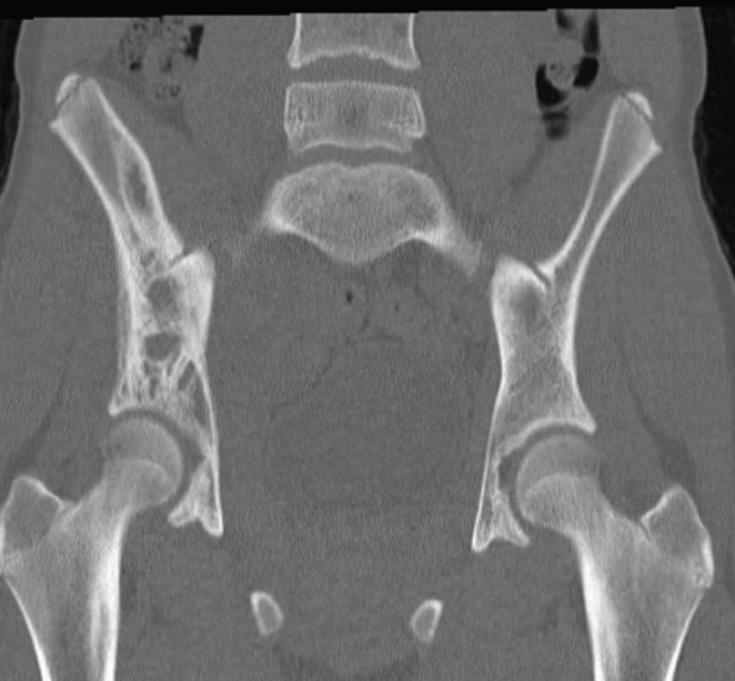 Figure 2 for case Ewing sarcoma ( RID4522 )